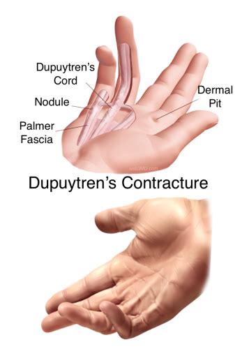 Dupuytren's Contracture