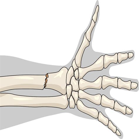 Radius Fracture 的图像结果