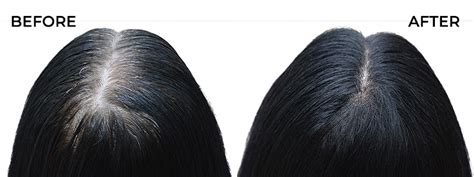 Mesotherapy For Hair in Bangalore | Best Hair Mesotherapy Clinic