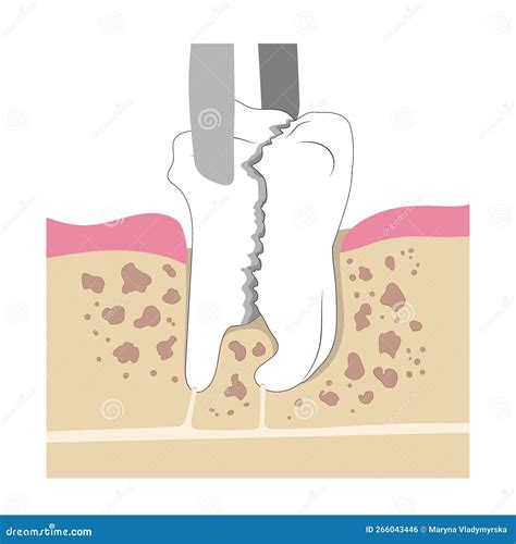 Image result for Broken Tooth Extraction