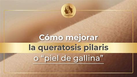 Queratosis Pilaris: ¿Qué es y Cómo Prevenirla? | SabanaDerma