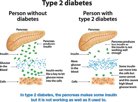 Type 2 diabetes, causes, symptoms, complications, diagnosis & treatment