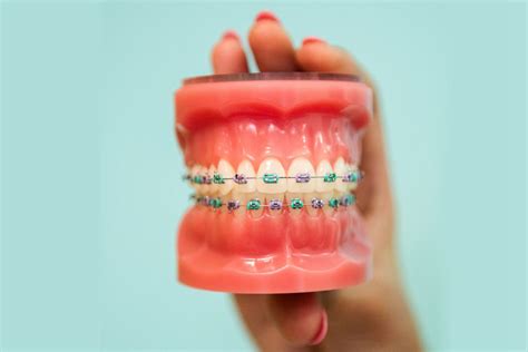 Image result for braces