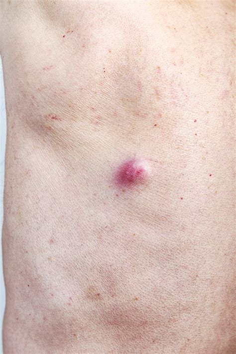 Skin Cyst On Back