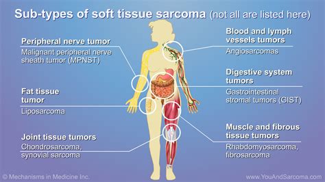 Image result for Soft Tissue Sarcoma Hand