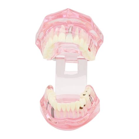 Dentalmall Teeth Model Teeth Typodonts Dental Implant Study India | Ubuy