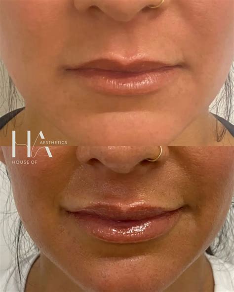 Lip Fillers Near You in Huntington Beach - Natural-looking Lips