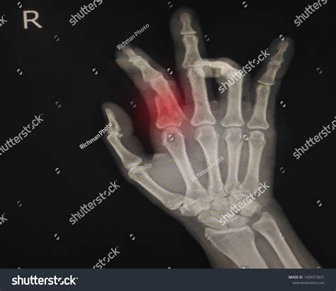 Hand Xray Fracture Index Finger OnẢnh có sẵn1429373621 | Shutterstock