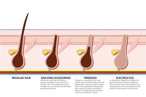 Is Electrolysis Permanent