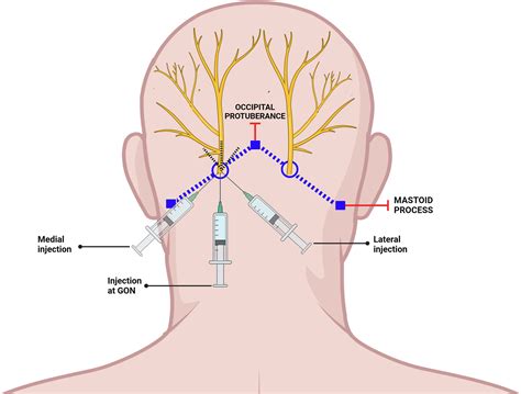 Occipital Nerve Block Needle