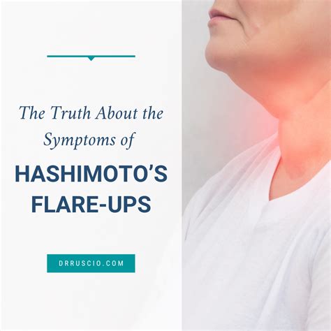 The Truth About the Symptoms of Hashimoto's Flare-Ups