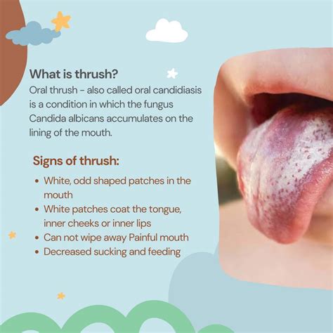 Normal Tongue Vs Thrush