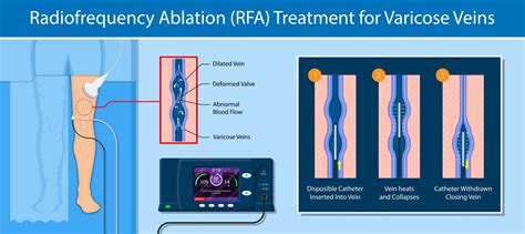 Laser Ablation For Venous Insufficiency at Adan Hillyard blog