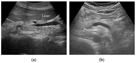 Fatty Pancreas: Its Potential as a Risk Factor for Pancreatic Cancer and Clinical Implications