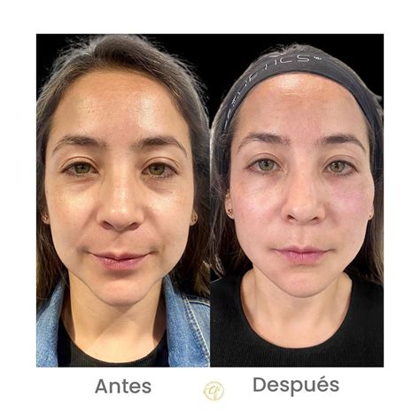 RADIESSE antes y después Bioestimuladores de Colágeno