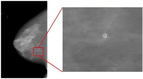 Breast Cancer Detection with an Ensemble of Deep Learning Networks ...
