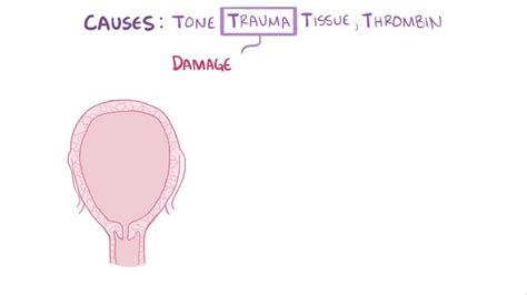 Postpartum Hemorrhage - Postpartum Hemorrhage - MSD Manual Professional ...