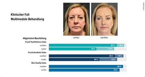 Filler sicher injizieren - Plastische Chirurgie - Universimed ...