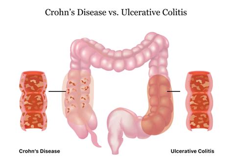 Colitis Vs. Cancer 的图像结果