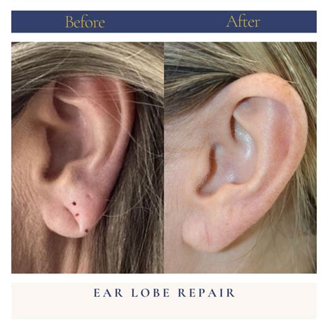 Ear Lobe Repair Archives | Kevin Caceres MD