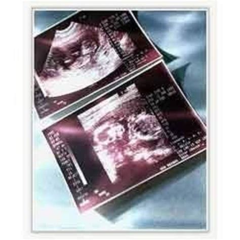 Pulse Print Sonography Lamination Sheet 11"x6.5" inch (Pack of 100 ...