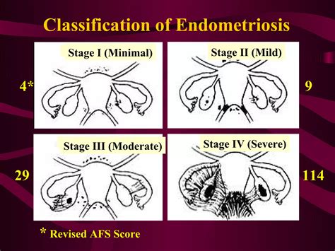 Endometriosis | PPT
