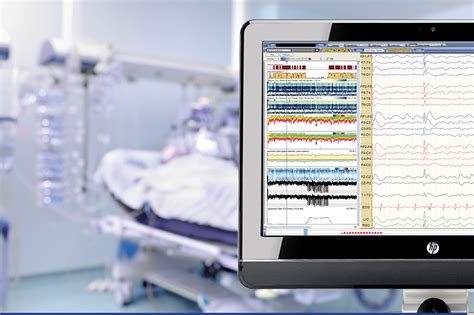 What Is Long Term Eeg Monitoring at Dana Boling blog