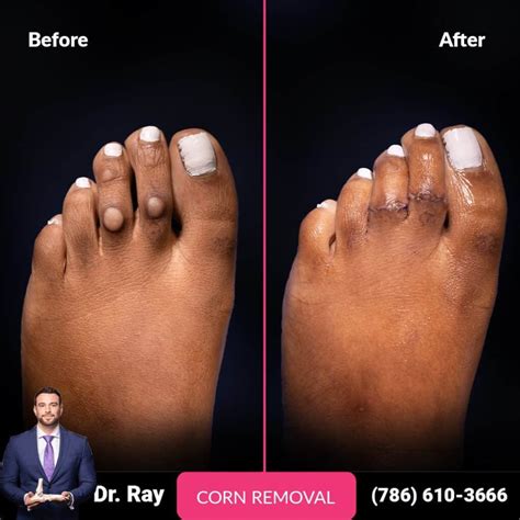 Corns On Feet Removal