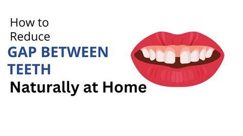 How To Reduce Gap Between Teeth Naturally At Home In Malayalam at Shanna Ornelas blog