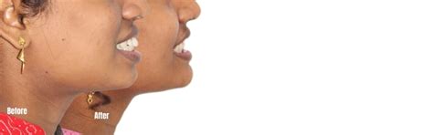 Braces & Invisalign Before After | Smile Transformation