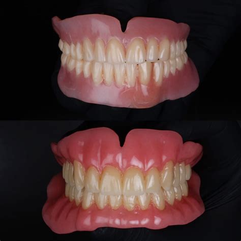 Types of Dentures: A Comprehensive Guide | The Vallance Dental Centre