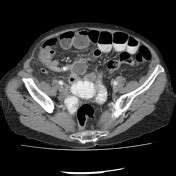 Image result for Perforated Appendix