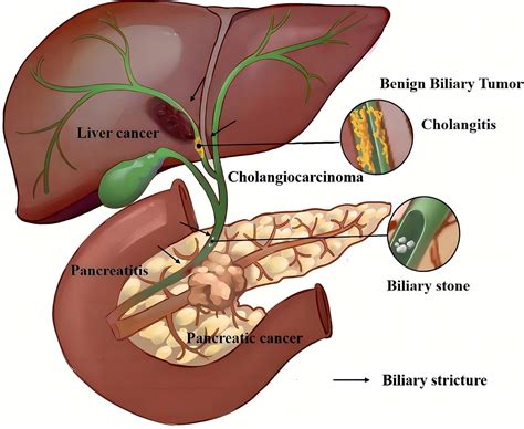 Frontiers | The past, present, and future of endoscopic management for biliary strictures ...