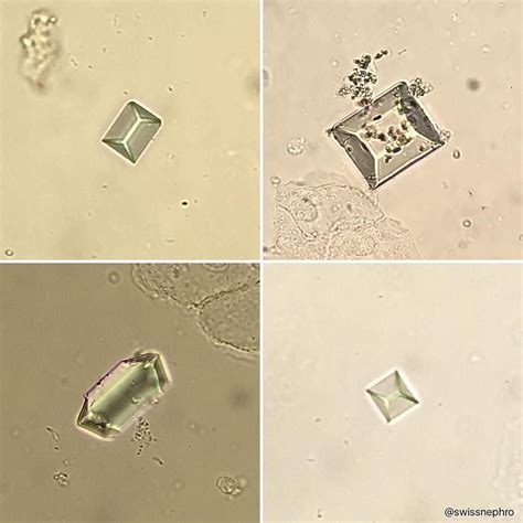 Triple phosphate crystals. (Bright field x400) #urinarysediment #urine ...