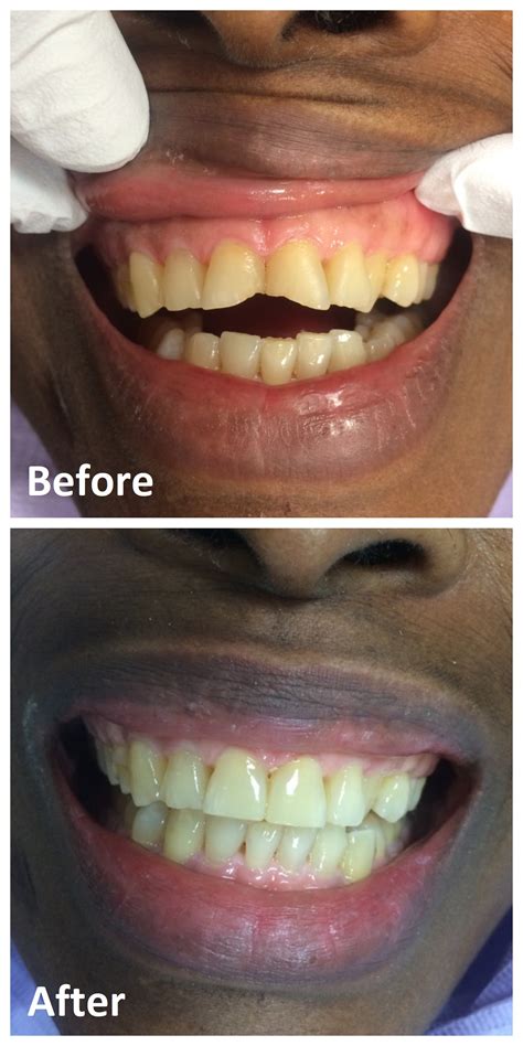 White Fillings Ottawa | Tooth-Colored Composite Fillings