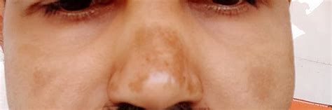 Mamaearth Bye Bye Blemishes* Face Cream, For Pigmentation & Blemish ...