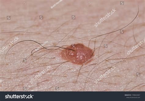 Mole On Face With Hair