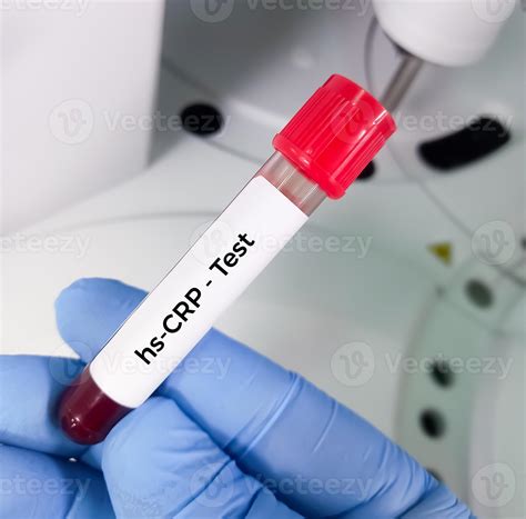 Hscrp Blood Test