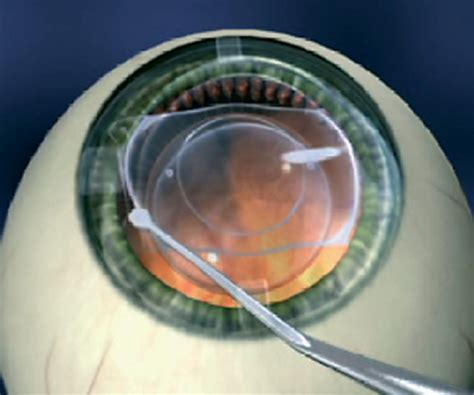Implantable Contact (Collamer) Lens - Dr Lynn Yeo | Experienced Eye Surgeon, Singapore