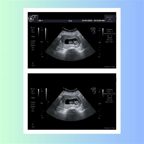 6 Week Ultrasound 2024