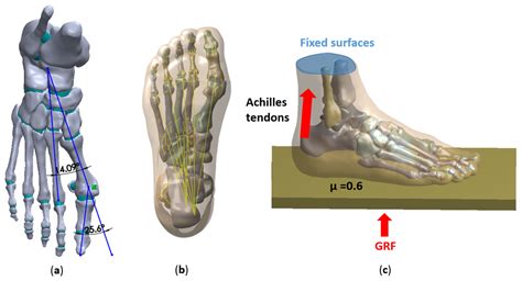 Effect of Displacement Degree of Distal Chevron Osteotomy on Metatarsal ...