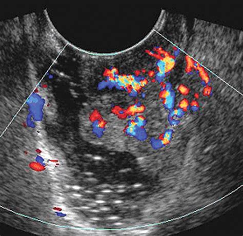Transvaginal Ultrasound Showing Cancer Role Of Imaging In The