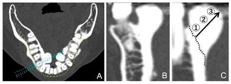 Computed Tomographic Analysis of Mandibular Tori and Their Relationship to Remaining Teeth