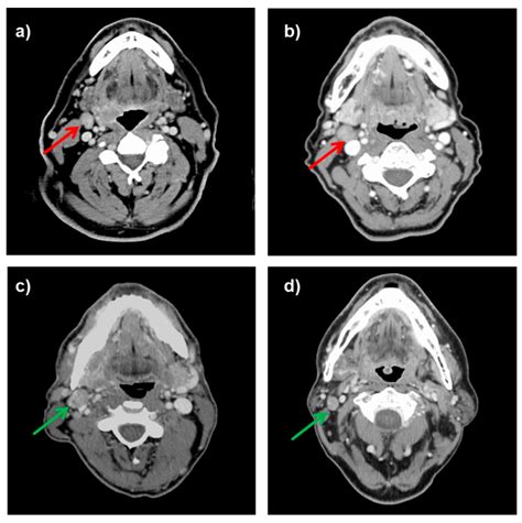 Posterior Cervical Lymph Nodes