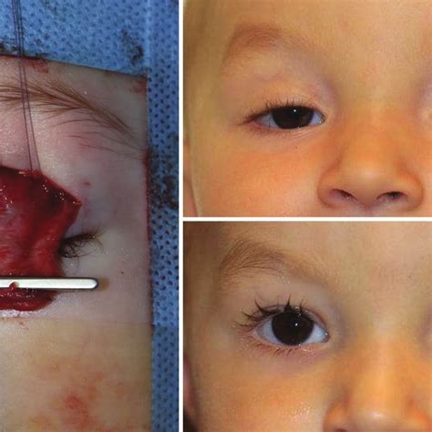 Image result for Levator Resection Surgery