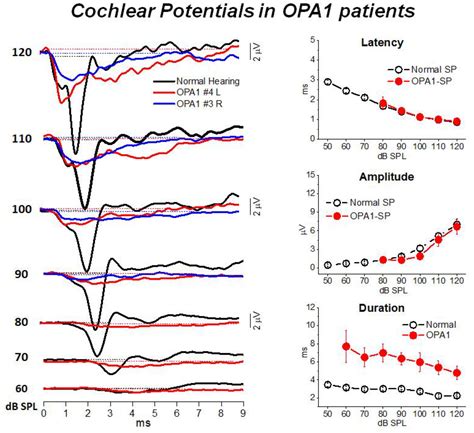 Electrocochleography in Auditory Neuropathy Related to Mutations in the ...