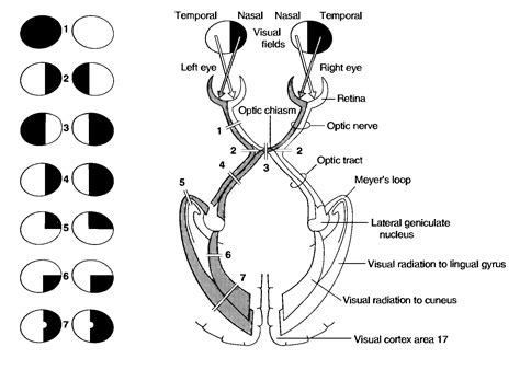 Quadrantanopia Visual Field Defect