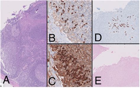 Lymphoma: Update on the Role of Imaging in the Understanding, Diagnosis ...