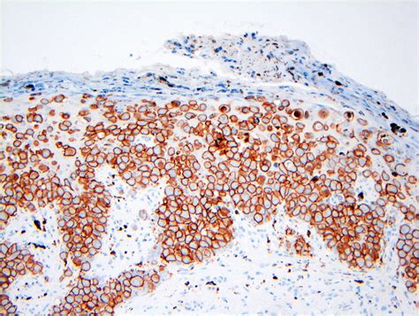 Paget's Disease Nipple Pathology Outlines at Tami Smith blog