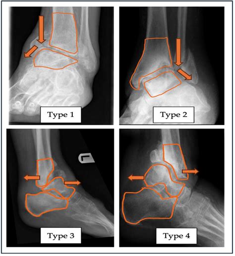 The Manchester Charcot Ankle Neuroarthropathy (M-CAN) Classification ...